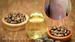 Rješite se bolnih žuljeva na prirodan način