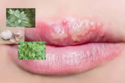 9 provjerenih prirodnih načina da izliječite herpes zoster