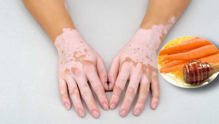 Vitiligo – Liječenje uz pomoć prirodnih lijekova